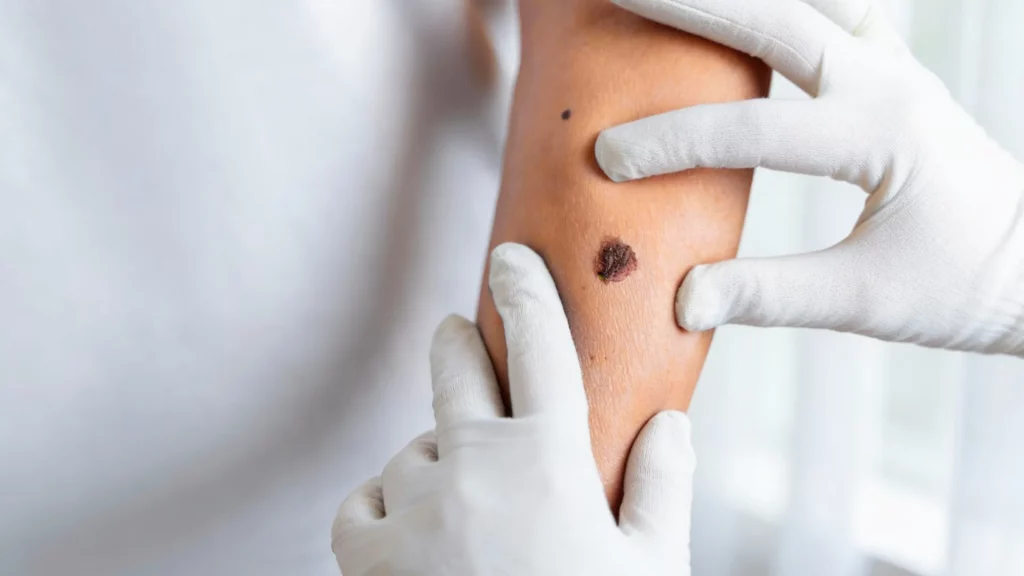 Cirugía de quistes y lesiones cutáneas en clínica médica en Málaga