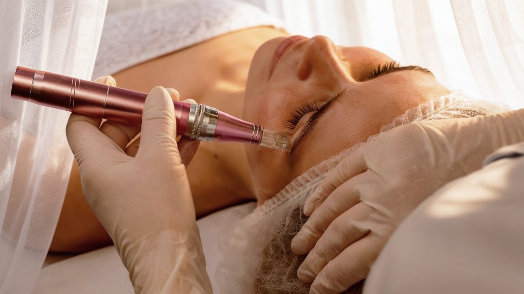 Levantamiento de párpados sin cirugía con Plasmapen en clínica estética en Málaga